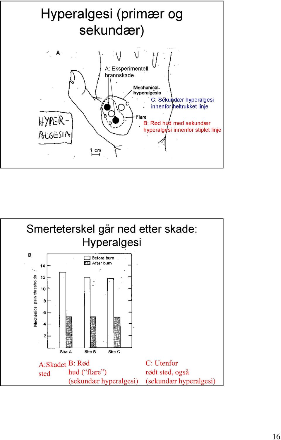 innenfor stiplet linje Smerteterskel går ned etter skade: Hyperalgesi A:Skadet