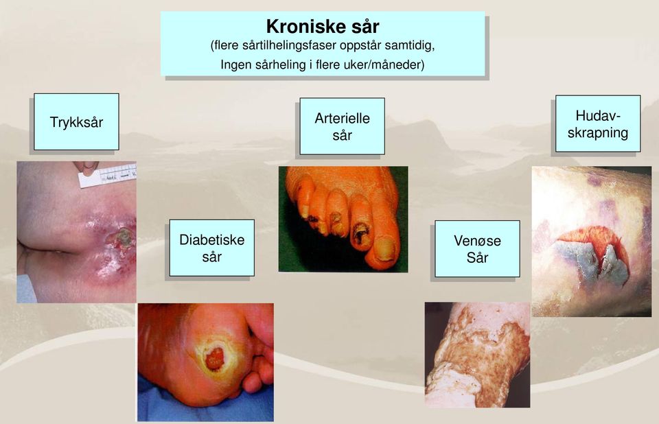 flere uker/måneder) Trykksår Arterielle