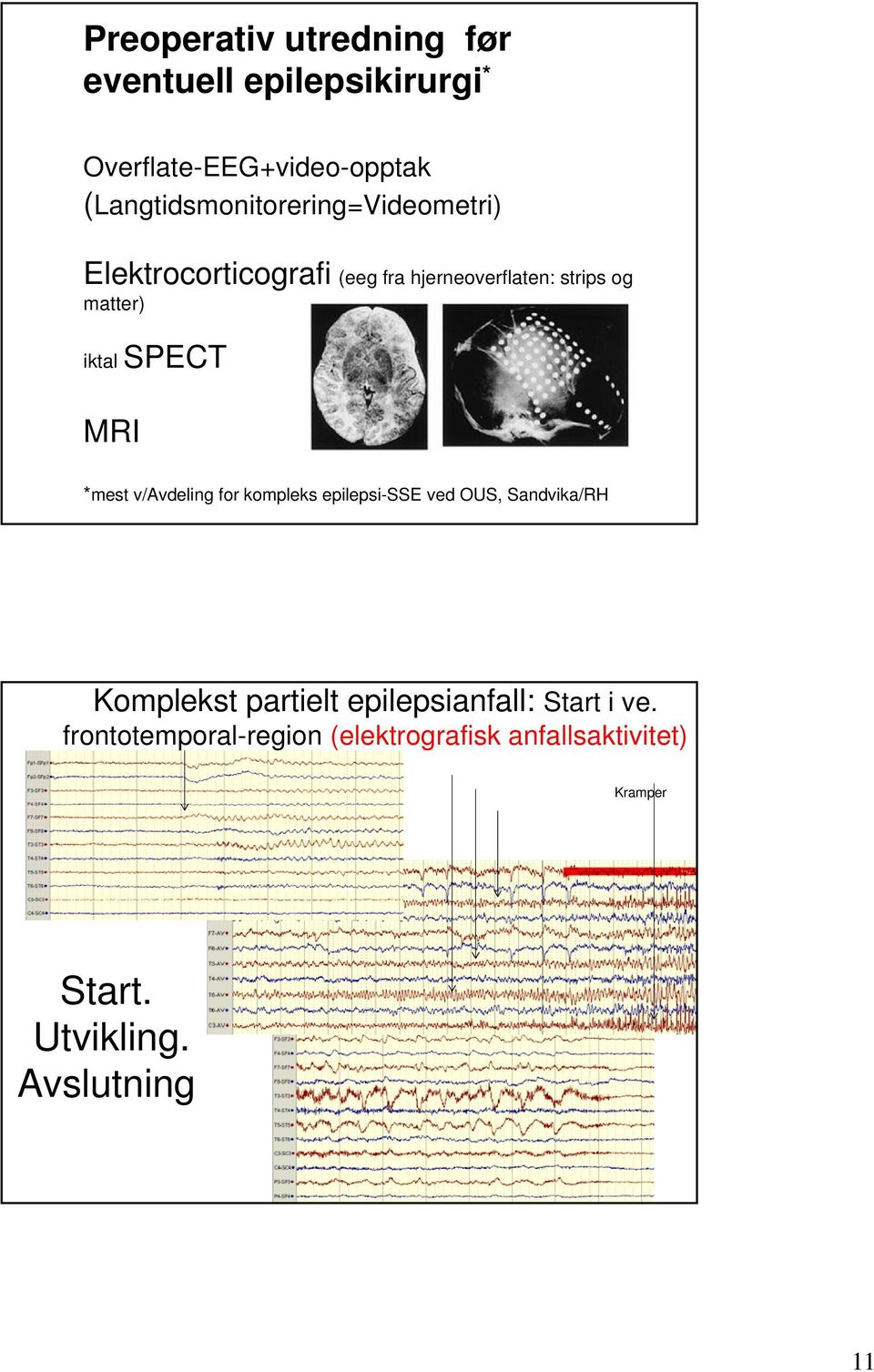 iktal SPECT MRI *mest v/avdeling for kompleks epilepsi-sse ved OUS, Sandvika/RH Komplekst partielt