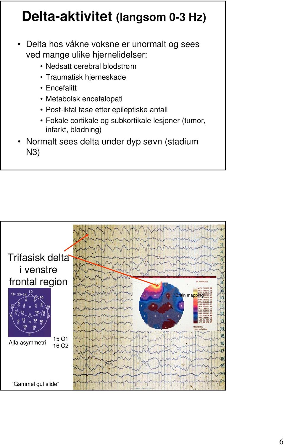 epileptiske anfall Fokale cortikale og subkortikale lesjoner (tumor, infarkt, blødning) Normalt sees delta under