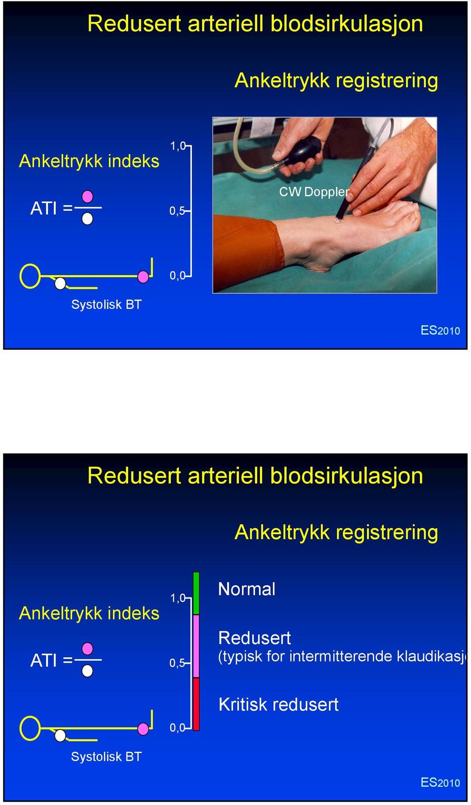 Normal Redusert (typisk for intermitterende klaudikasjo Systolisk BT 0,0