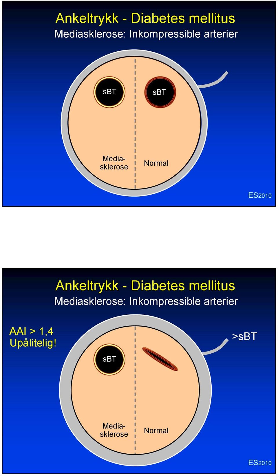 arterier AAI > 1,4 Upålitelig!