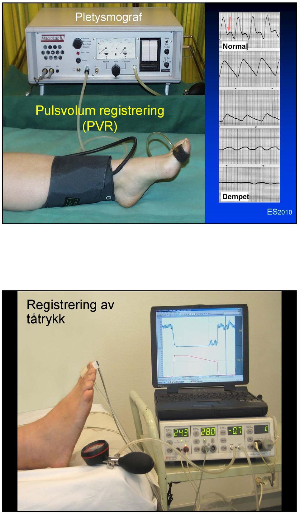 registrering (PVR)