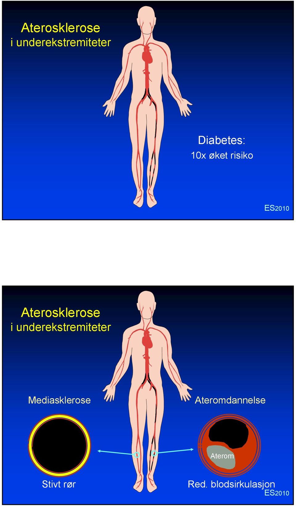 Ateromdannelse Aterom Stivt rør Red.