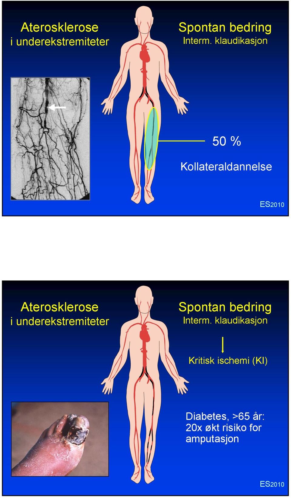 ischemi (KI) Diabetes, >65 år: 20x økt risiko for