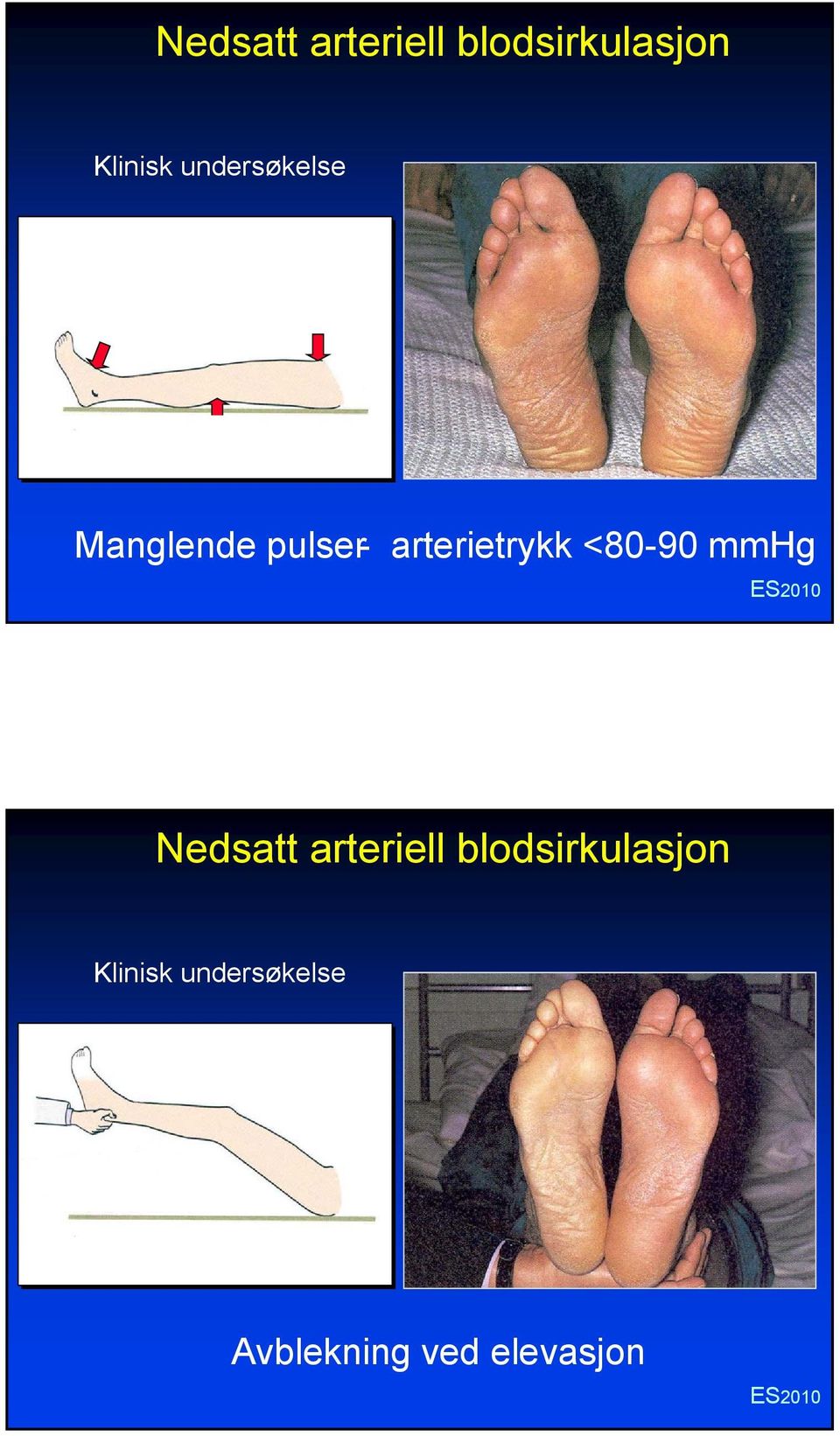 <80-90 mmhg  undersøkelse Avblekning ved