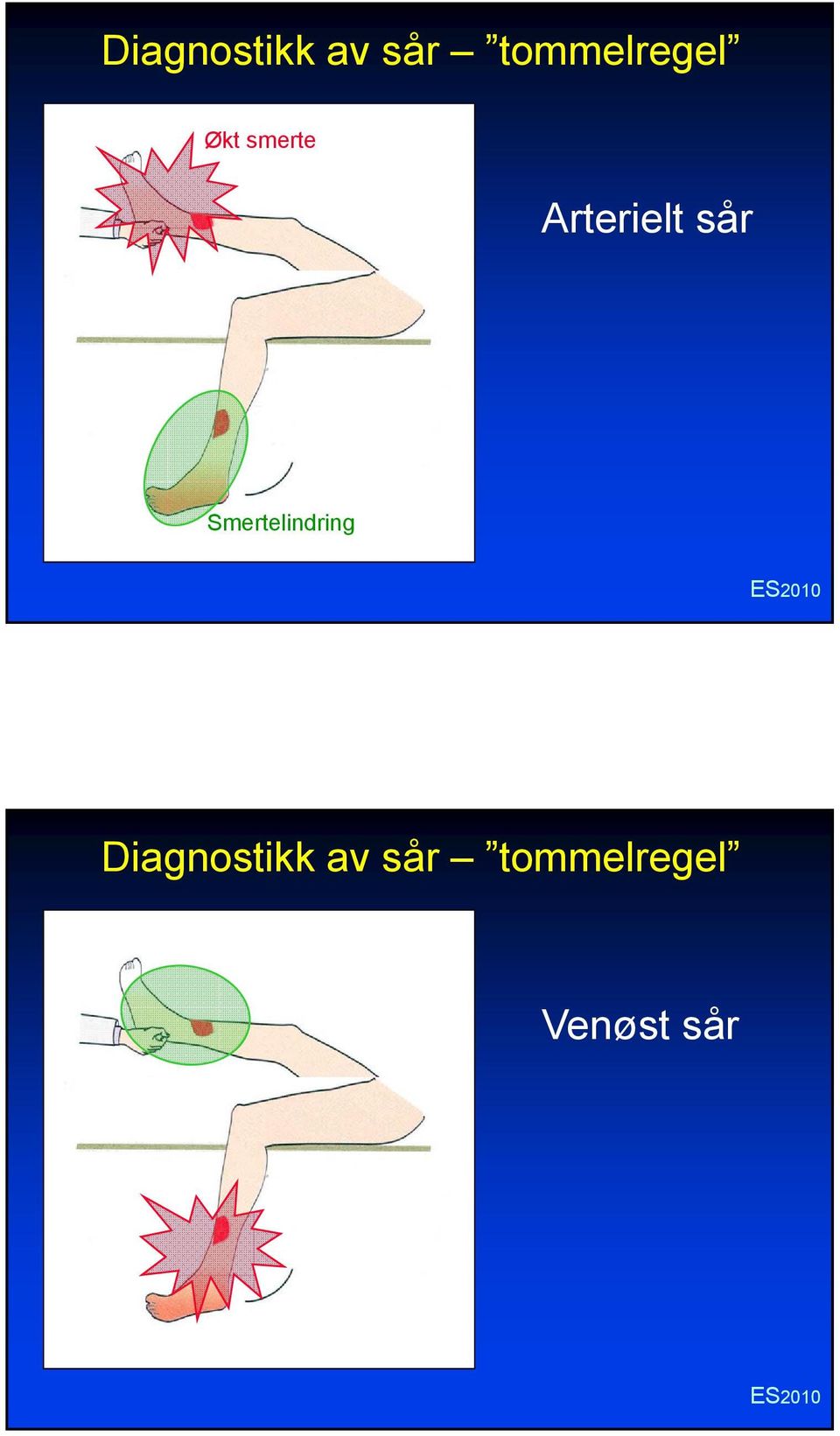 Arterielt sår Smertelindring