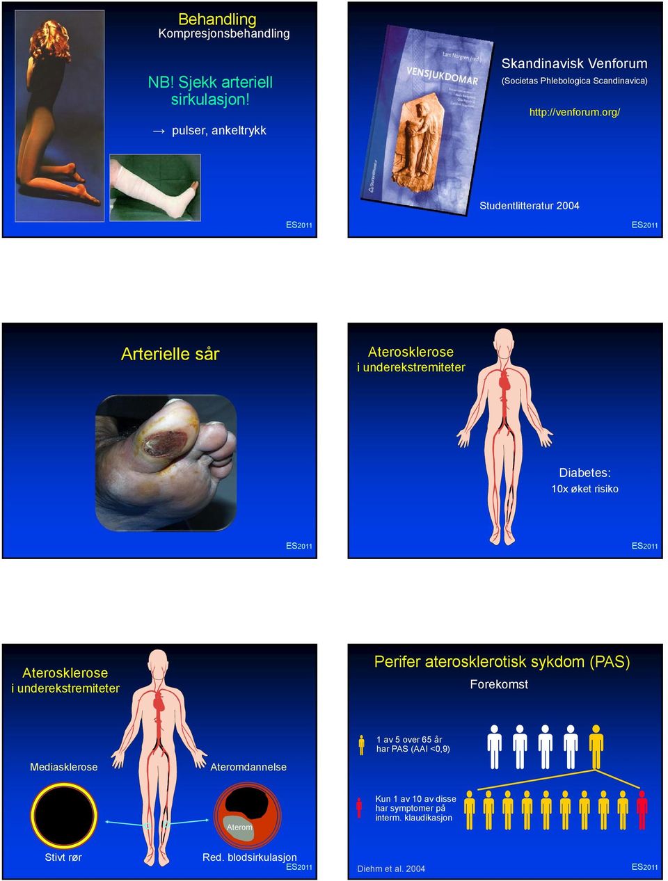 org/ Studentlitteratur 2004 Arterielle sår Aterosklerose i underekstremiteter Diabetes: 10x øket risiko Aterosklerose i