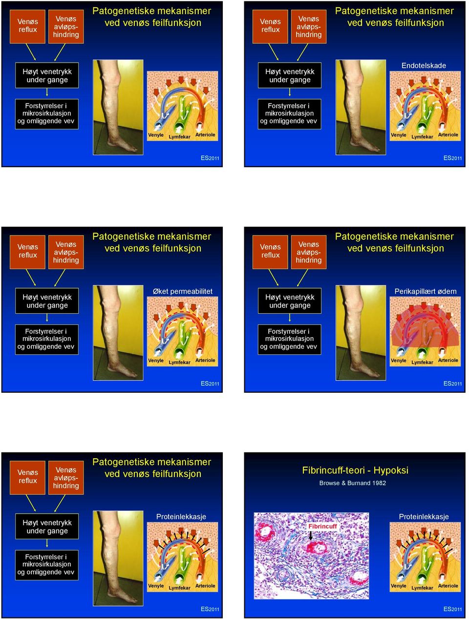 Patogenetiske mekanismer ved venøs feilfunksjon reflux avløpshindring Patogenetiske mekanismer ved venøs feilfunksjon Høyt venetrykk under gange Øket permeabilitet Høyt venetrykk under gange