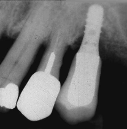 Oral biofilm Oral sykdom Dental karies