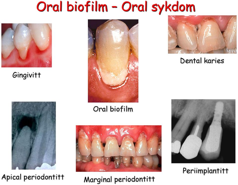 Gingivitt Oral biofilm