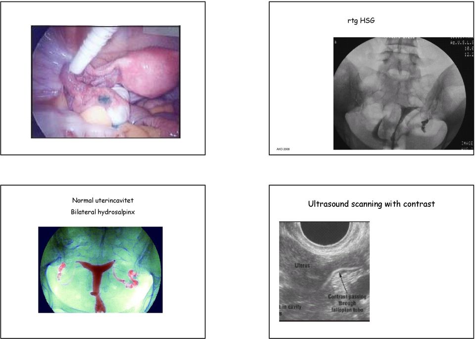 hydrosalpinx Ultrasound