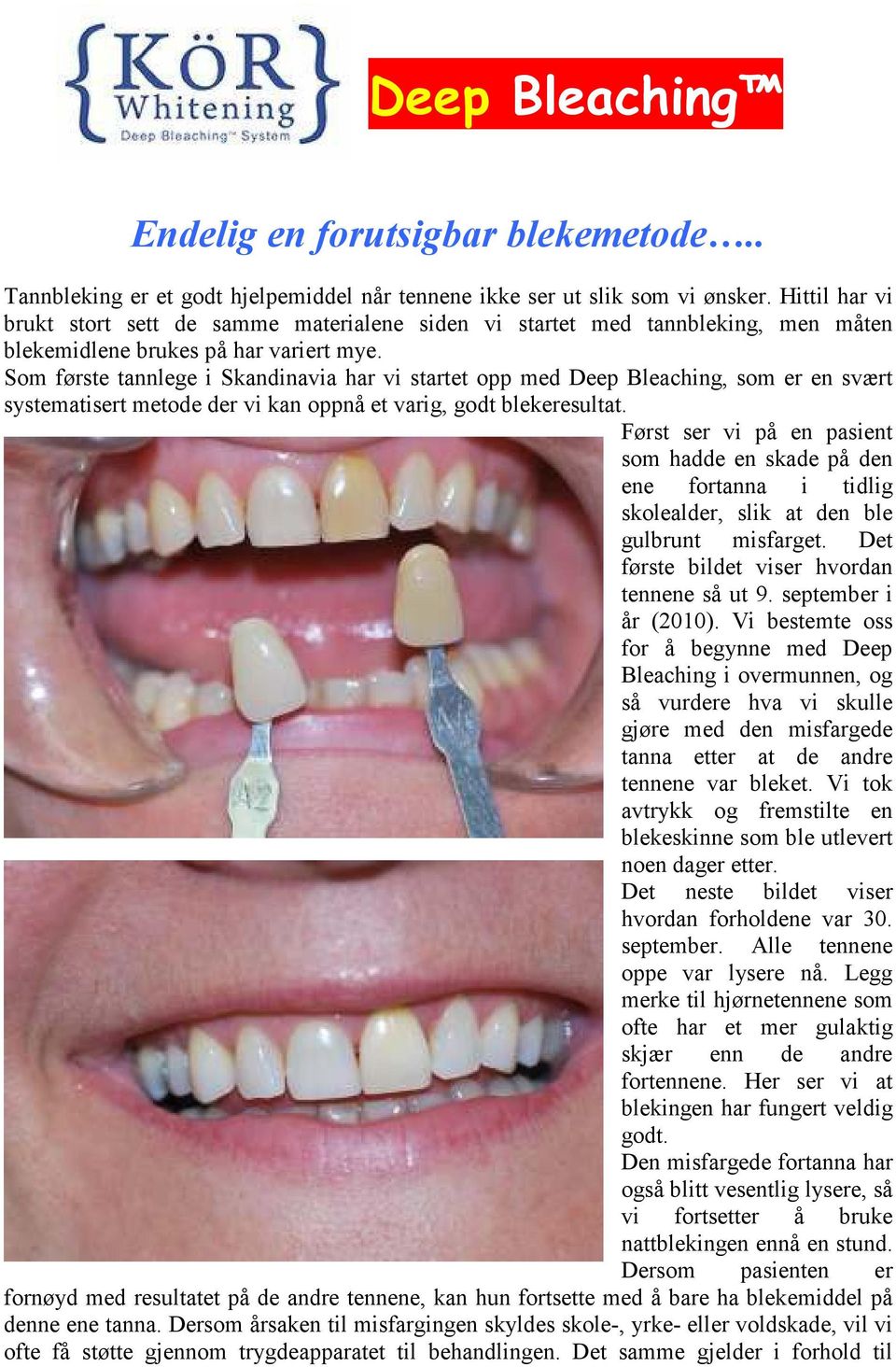 Som første tannlege i Skandinavia har vi startet opp med Deep Bleaching, som er en svært systematisert metode der vi kan oppnå et varig, godt blekeresultat.