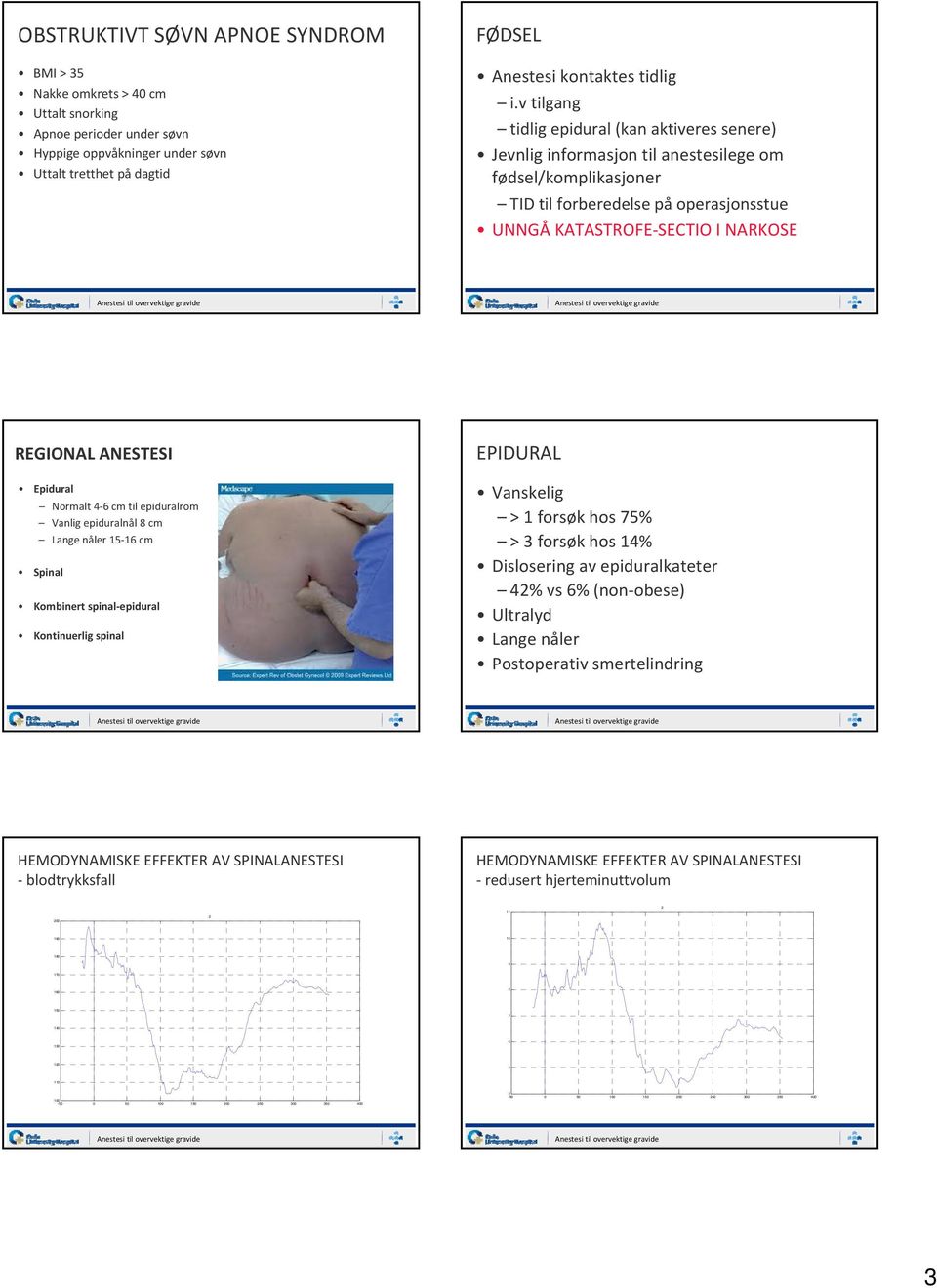 ANESTESI Epidural Normalt4 6 cm til epiduralrom Vanlig epiduralnål 8 cm Lange nåler 15 16 cm Spinal Kombinert spinal epidural Kontinuerlig spinal EPIDURAL Vanskelig > 1 forsøk hos 75% > 3 forsøk hos