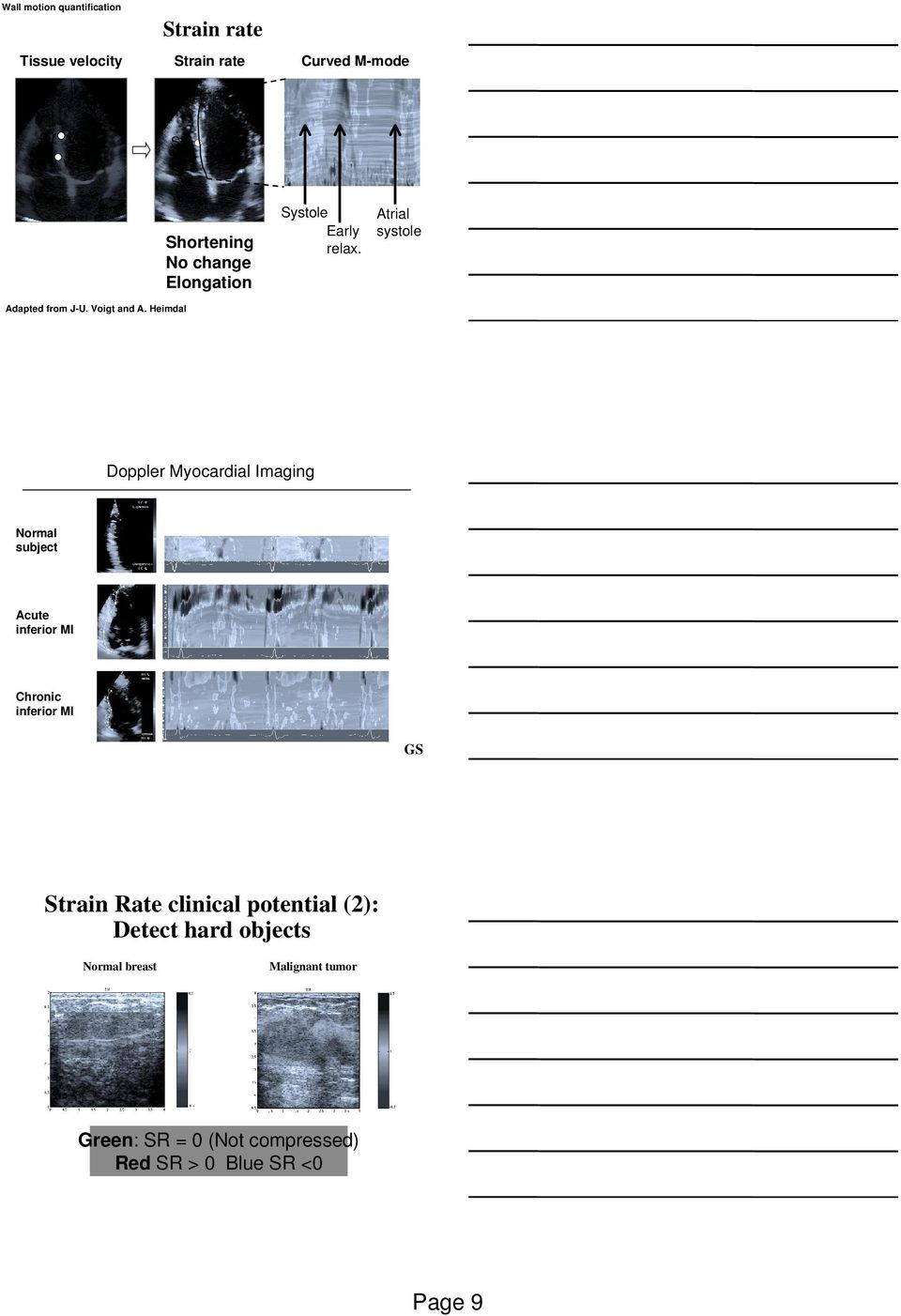 Heimdal Doppler Myocardial Imaging Normal subject Acute inferior MI Chronic inferior MI GS Strain Rate