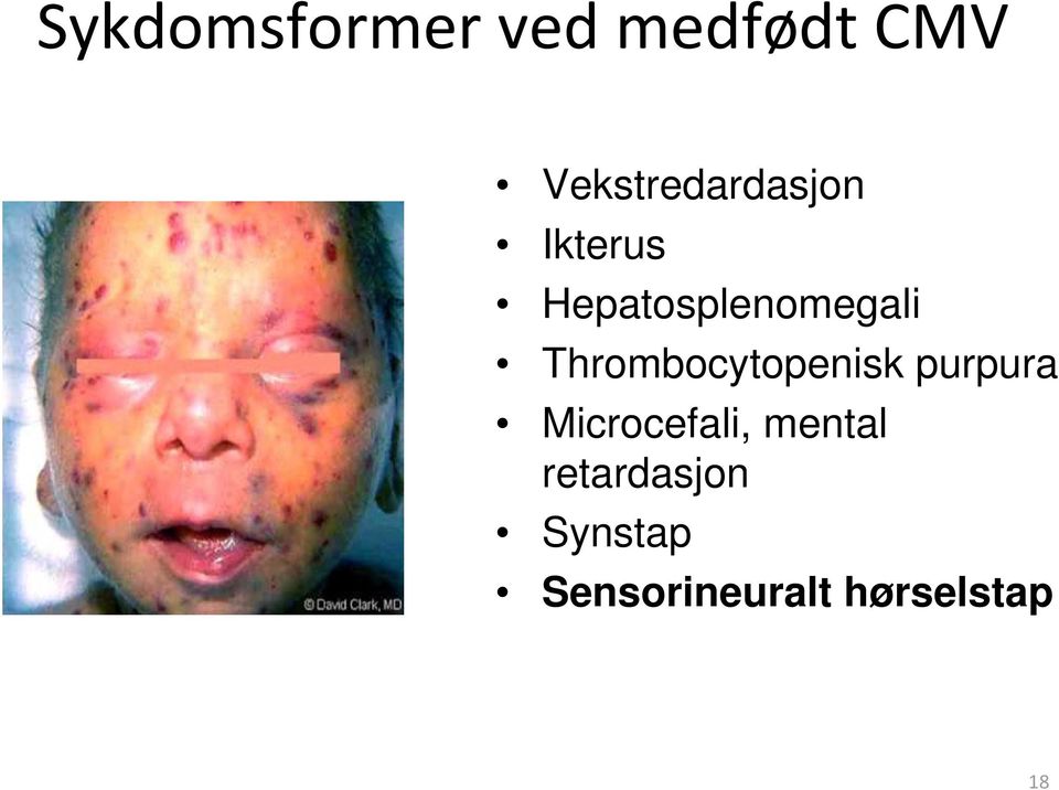 Hepatosplenomegali Thrombocytopenisk