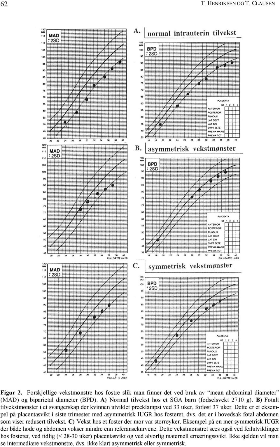 Dette er et eksempel på placentasvikt i siste trimester med asymmetrisk IUGR hos fosteret, dvs. det er i hovedsak føtal abdomen som viser redusert tilvekst.