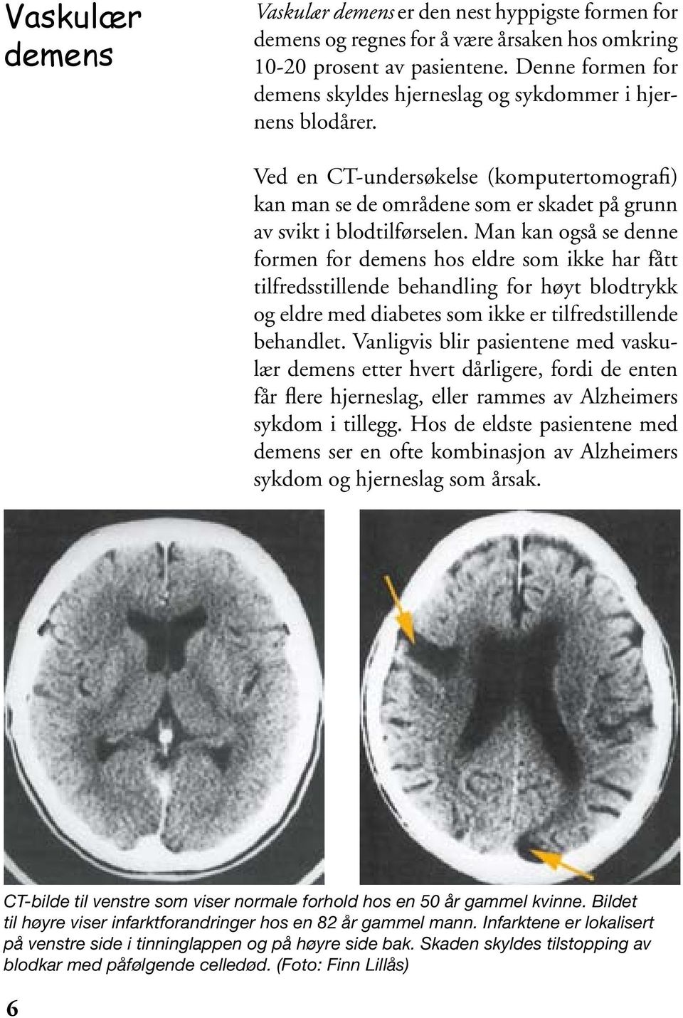 Man kan også se denne formen for demens hos eldre som ikke har fått tilfredsstillende behandling for høyt blodtrykk og eldre med diabetes som ikke er tilfredstillende behandlet.