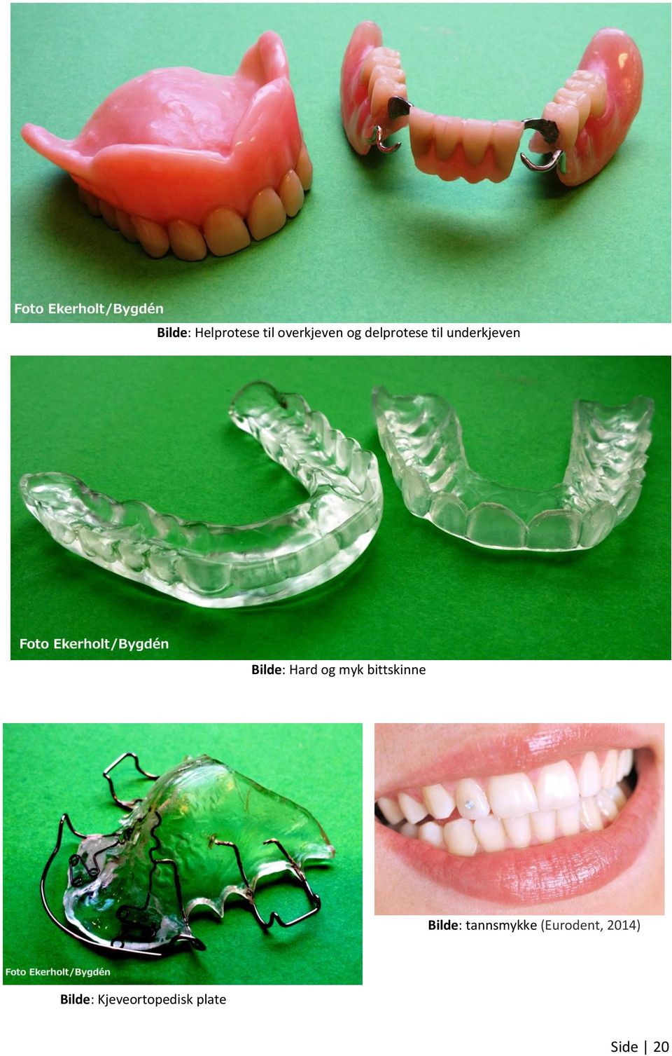 og myk bittskinne Bilde: tannsmykke