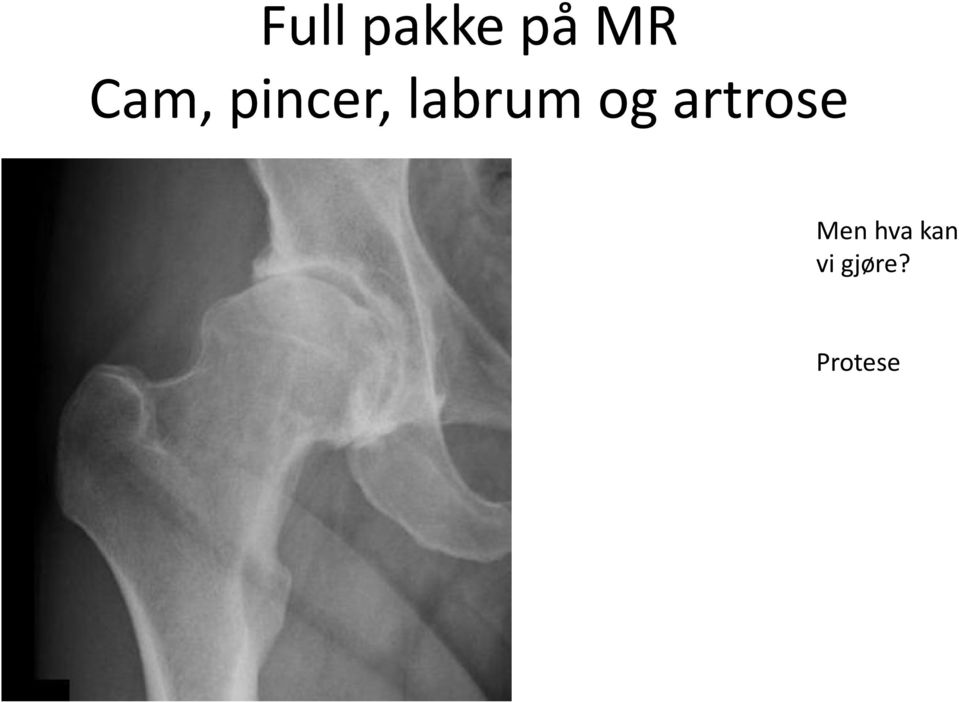 og artrose Men hva