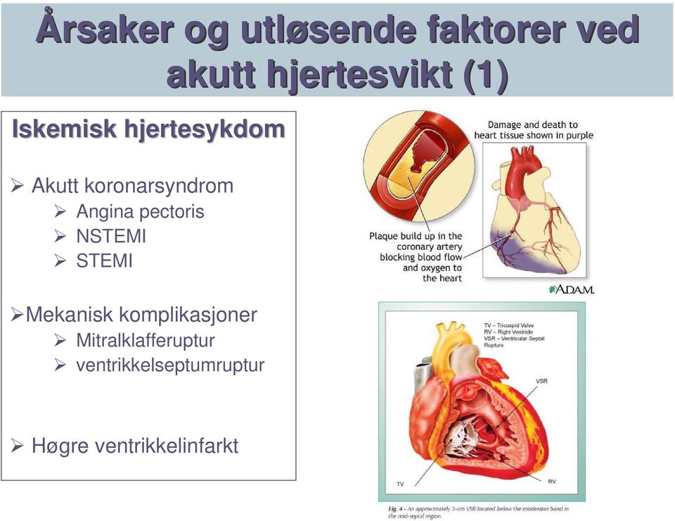 koronarsyndrom Angina pectoris NSTEMI STEMI Mekanisk