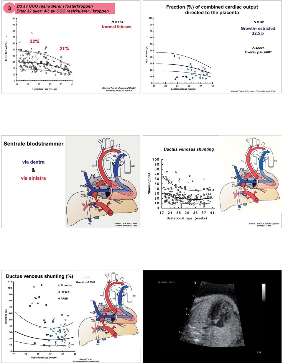 5 p Z-score Overall p<.1 Kiserud T et al.