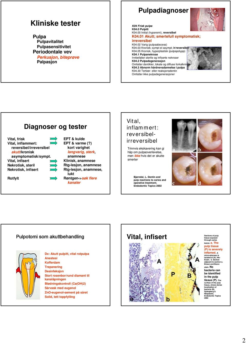 1 Pulpanekrose Innbefatter sterile og infiserte nekroser K04.2 Pulpadegenerasjon Omfatter dentikler, lokale og diffuse forkalkninger K04.3 Abnorm hårdvevsdannelse i pulpa K04.