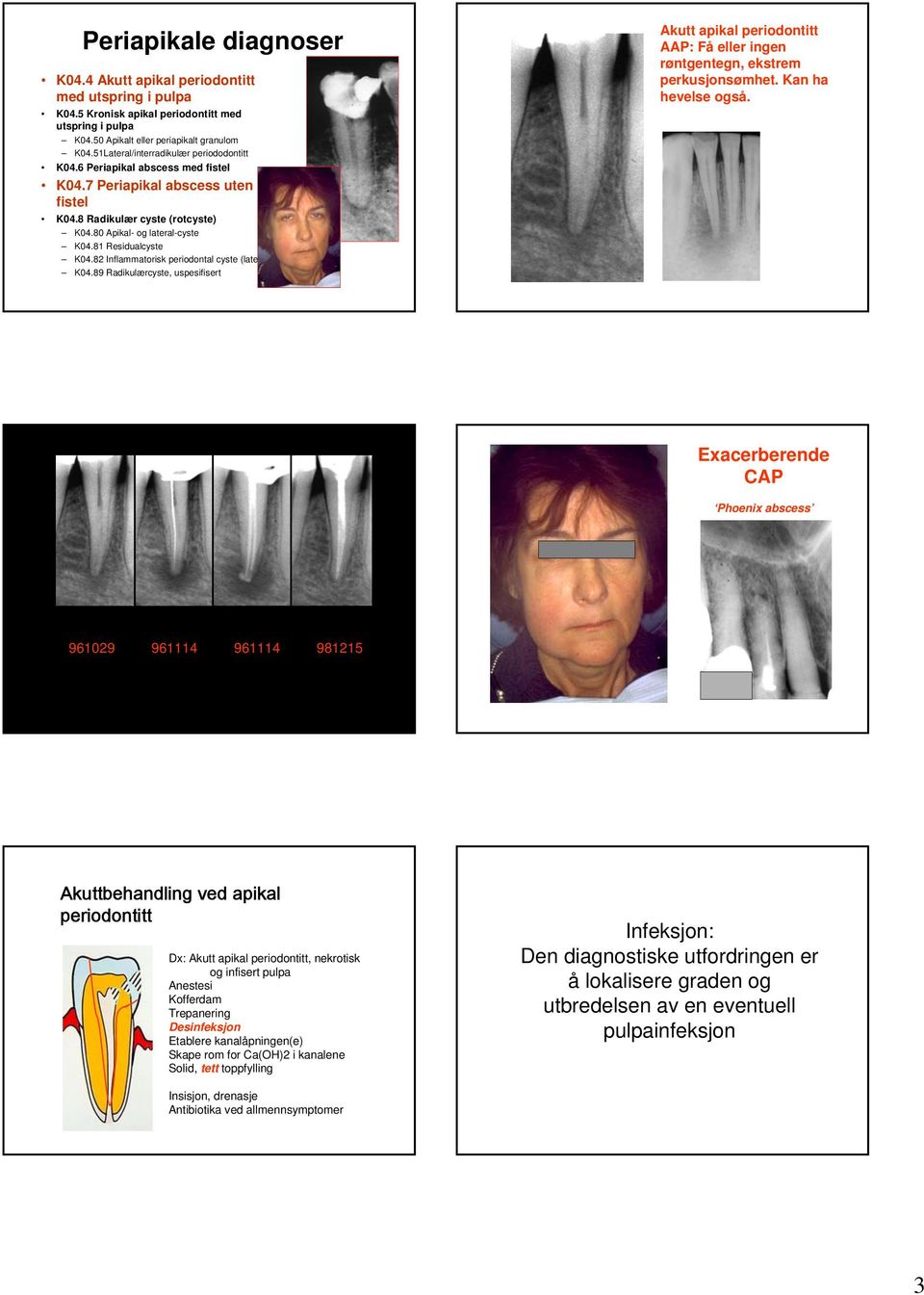 81 Residualcyste K04.82 Inflammatorisk periodontal cyste (lateral) K04.89 Radikulærcyste, uspesifisert Akutt apikal periodontitt AAP: Få eller ingen røntgentegn, ekstrem perkusjonsømhet.