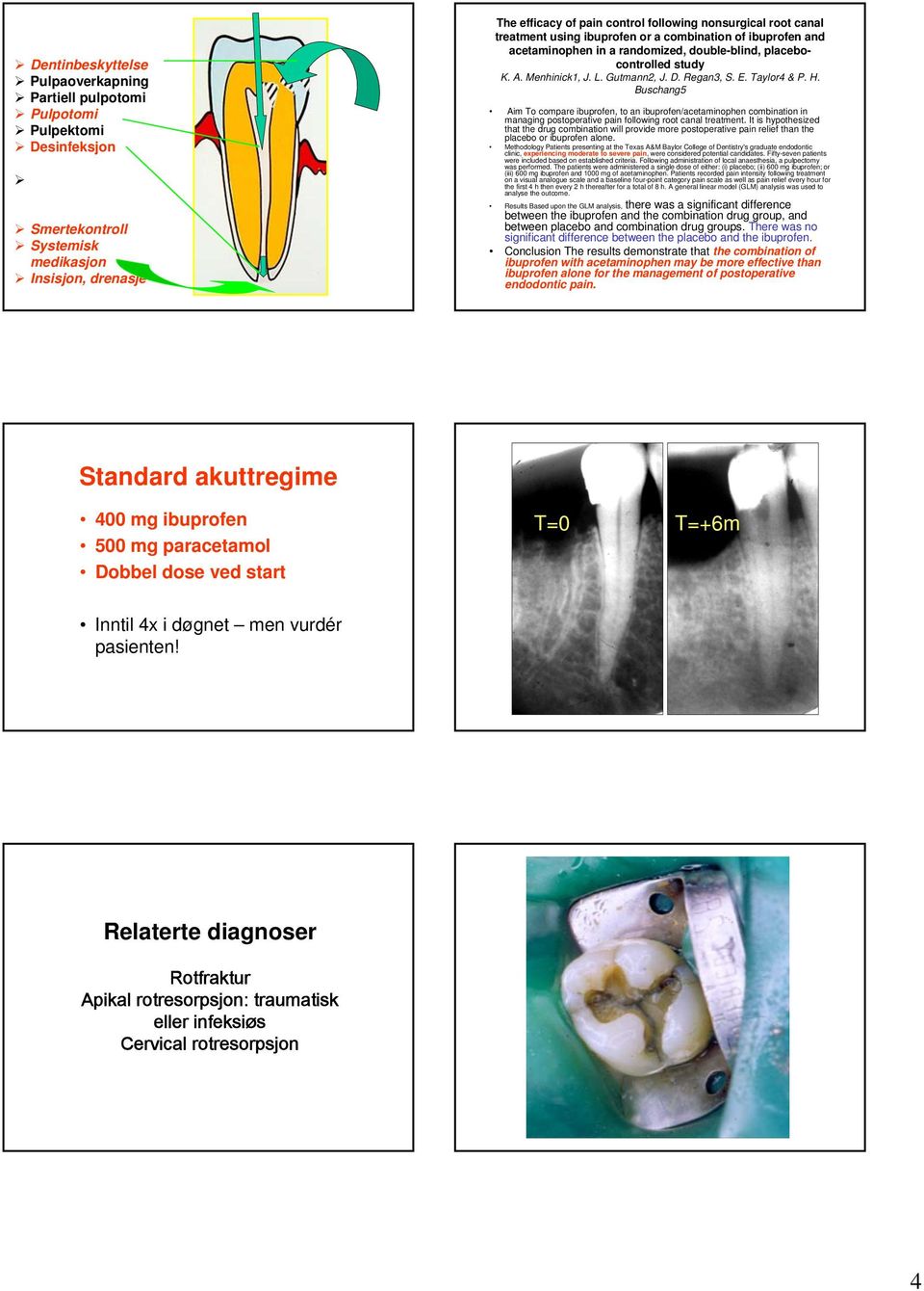 Taylor4 & P. H. Buschang5 Aim To compare ibuprofen, to an ibuprofen/acetaminophen combination in managing postoperative pain following root canal treatment.