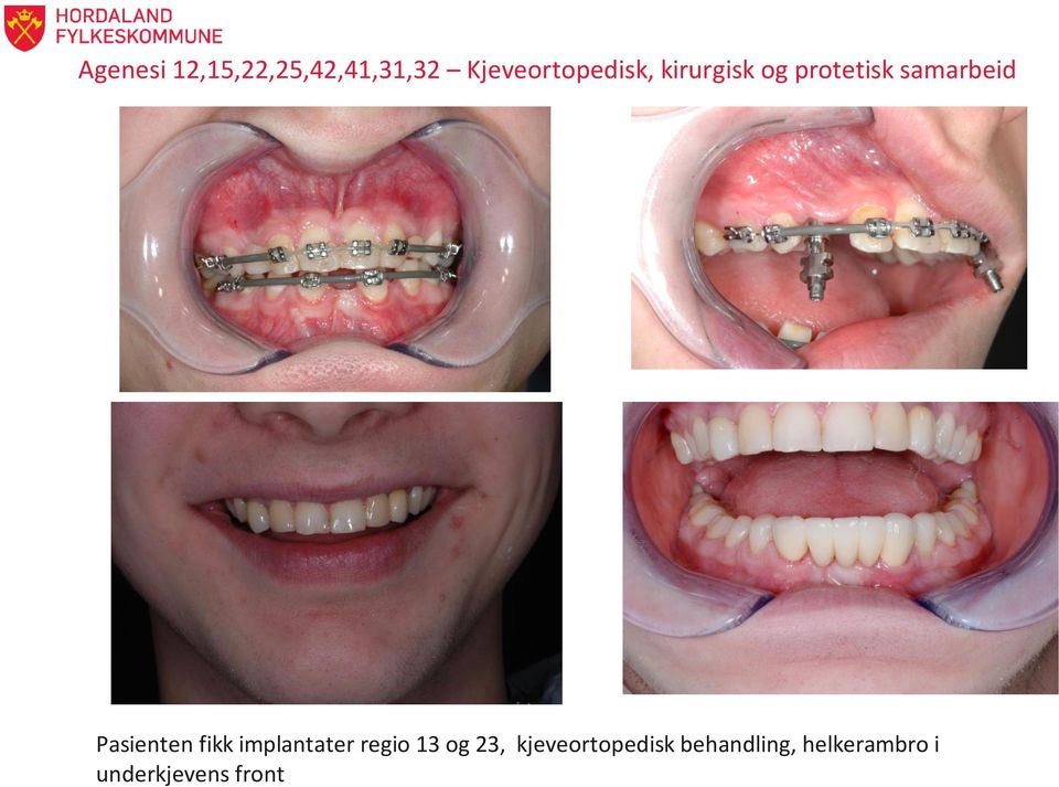 samarbeid Pasienten fikk implantater regio 13