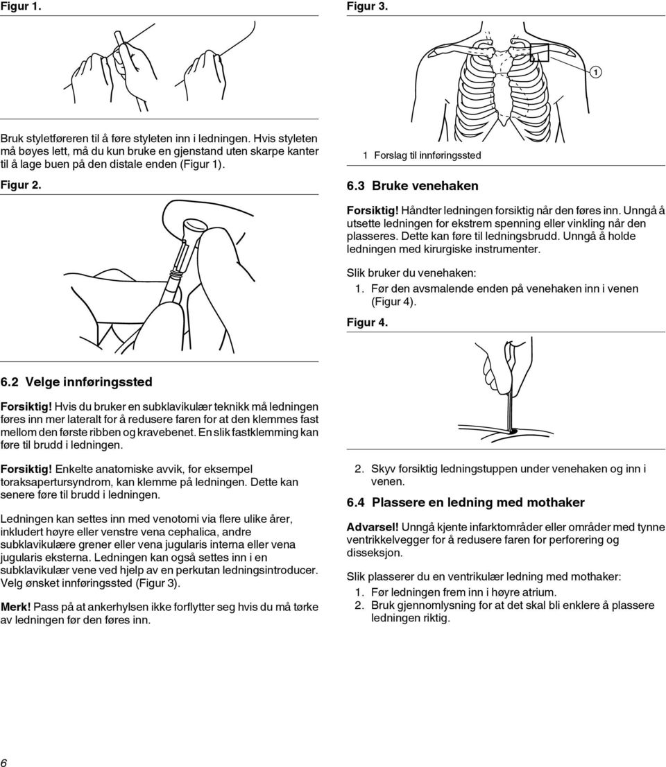 Dette kan føre til ledningsbrudd. Unngå å holde ledningen med kirurgiske instrumenter. Slik bruker du venehaken: 1. Før den avsmalende enden på venehaken inn i venen (Figur 4). Figur 4. 6.