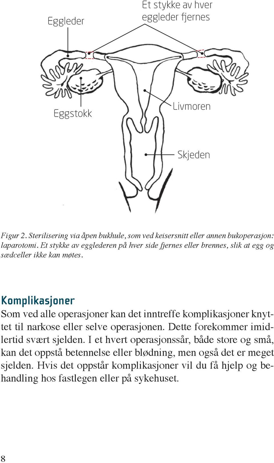 Et stykke av egglederen på hver side fjernes eller brennes, slik at egg og sædceller ikke kan møtes.