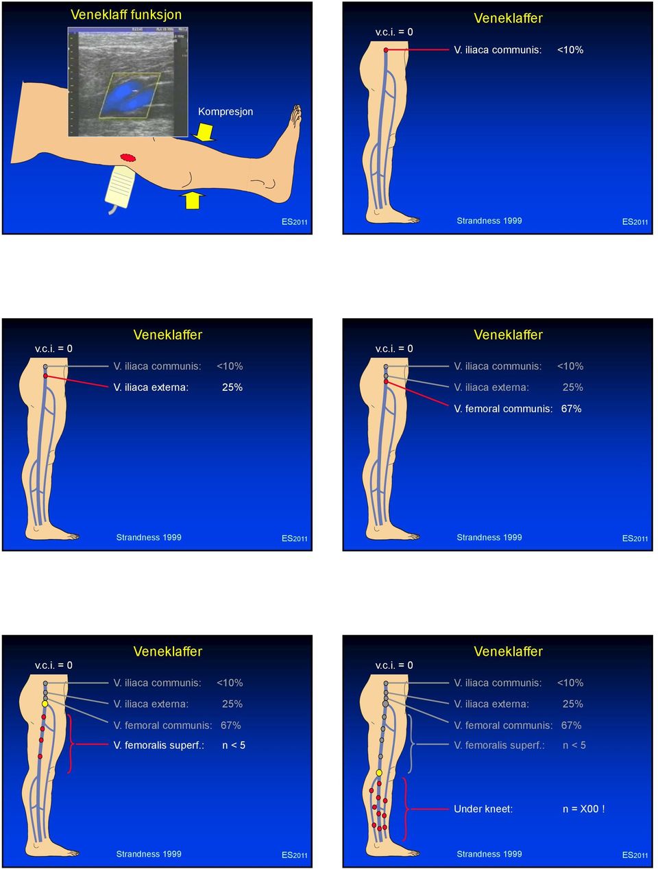 c.i. = Veneklaffer V. iliaca communis: <1% V. iliaca communis: <1% V. iliaca externa: 25% V. iliaca externa: 25% V. femoral communis: 67% V.