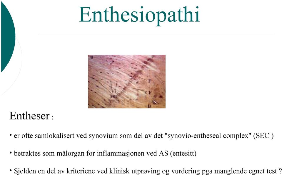 målorgan for inflammasjonen ved AS (entesitt) Sjelden en del av