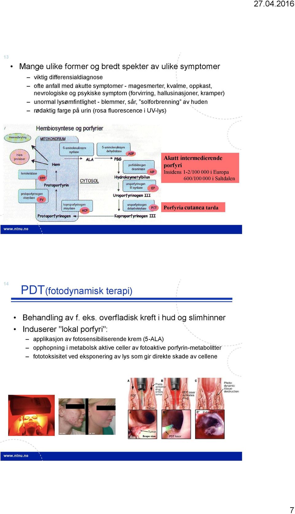 Insidens 1-2/100 000 i Europa 600/100 000 i Saltdalen Porfyria cutanea tarda 14 PDT(fotodynamisk terapi) Behandling av f. eks.