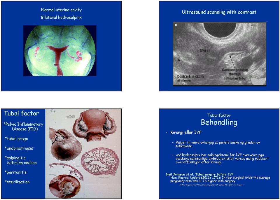 salpingektomi før IVF overveies pga væskens sannsynlige embryotoxisitet versus mulig redusert ovariaffunksjon etter kirurgi. Neil Johnson et al.:tubal surgery before IVF Hum.