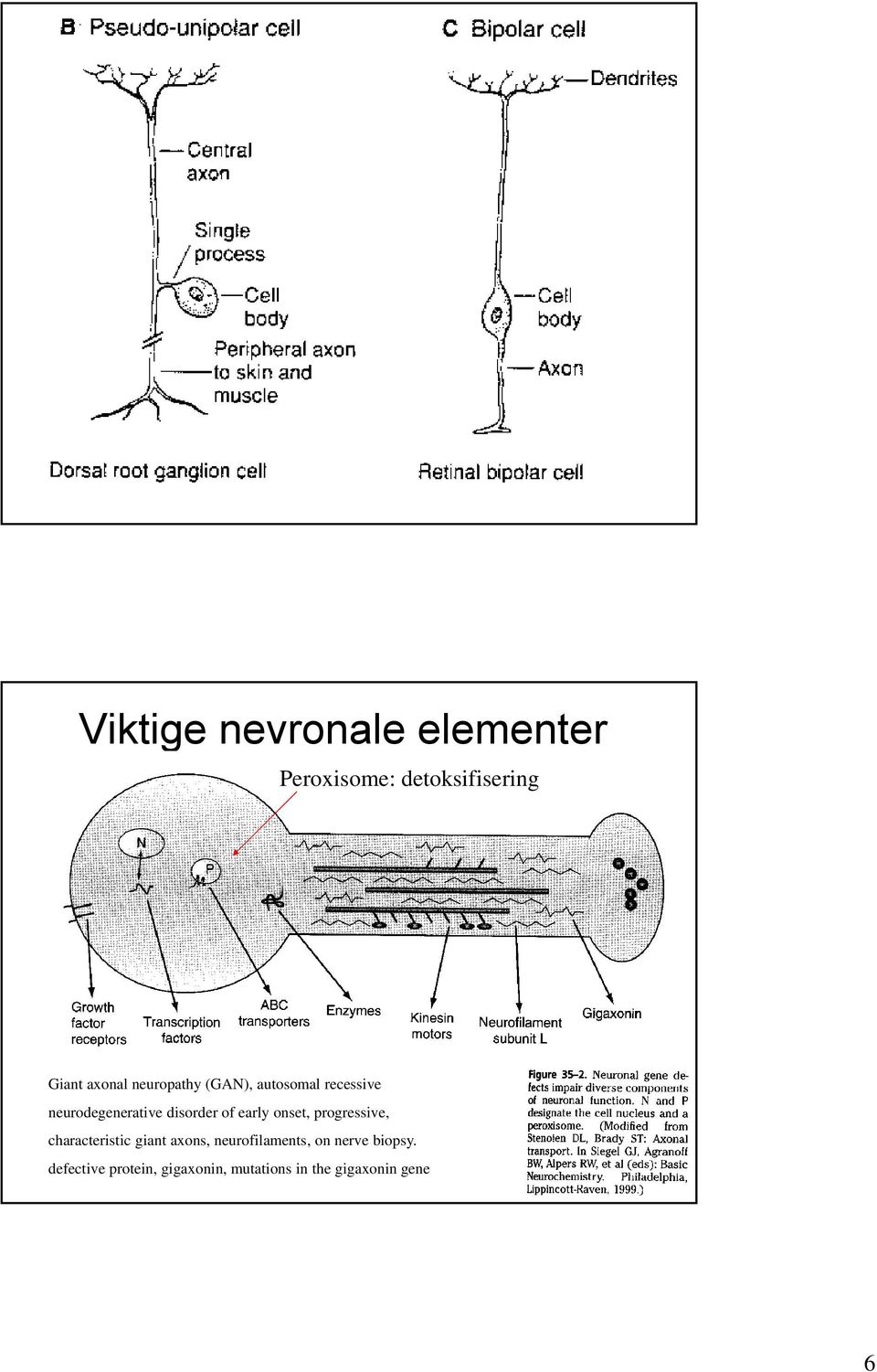 early onset, progressive, characteristic giant axons, neurofilaments,