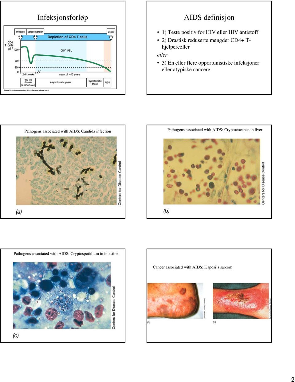 Pathogens associated with AIDS: Candida infection Pathogens associated with AIDS: Cryptococchus in liver
