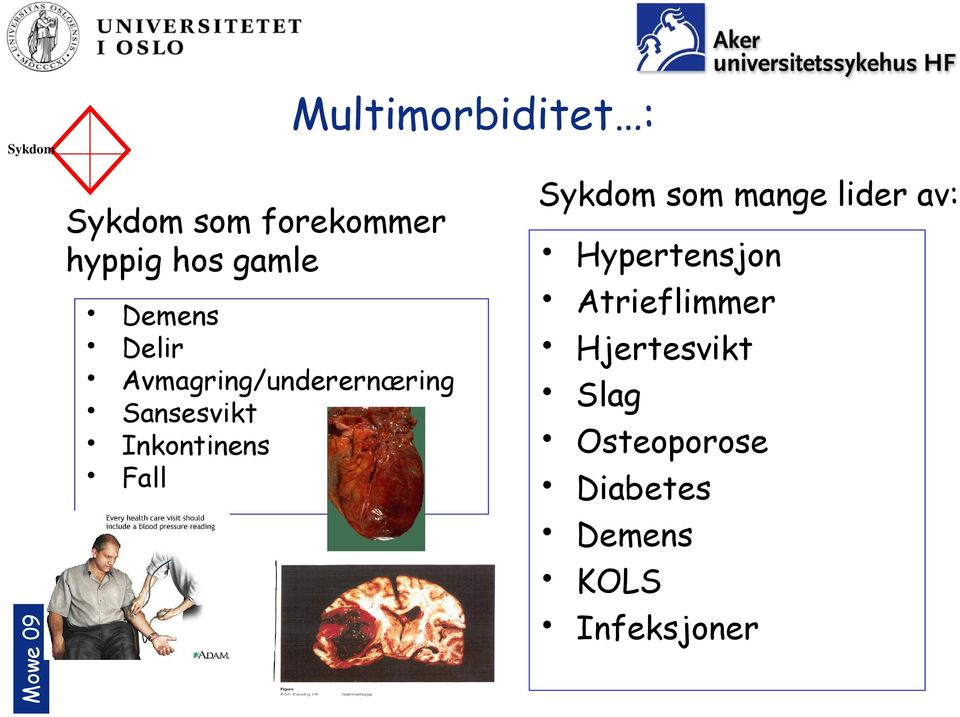 Multimorbiditet : Sykdom som mange lider av: Hypertensjon