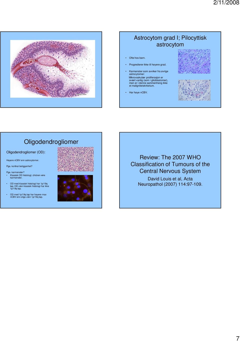 Har høye ncbv. Oligodendrogliomer Oligodendrogliomer (OD): Høyere ncbv enn astrocytomer. Pga. kortikal beliggenhet? Pga. karmønster? Klassisk OD histologi; chicken-wire karmønster.