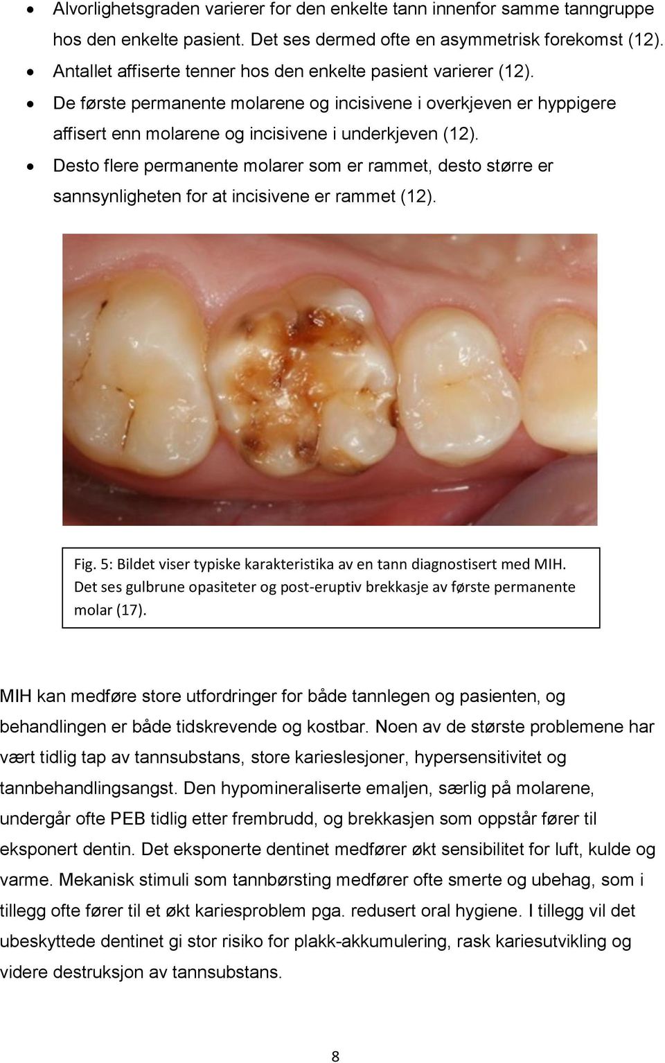 Desto flere permanente molarer som er rammet, desto større er sannsynligheten for at incisivene er rammet (12). Fig. 5: Bildet viser typiske karakteristika av en tann diagnostisert med MIH.