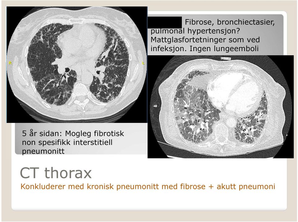 Ingen lungeemboli 5 år sidan: Mogleg fibrotisk non spesifikk