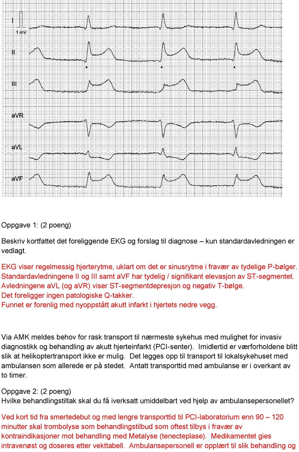 Avledningene avl (og avr) viser ST-segmentdepresjon og negativ T-bølge. Det foreligger ingen patologiske Q-takker. Funnet er forenlig med nyoppstått akutt infarkt i hjertets nedre vegg.