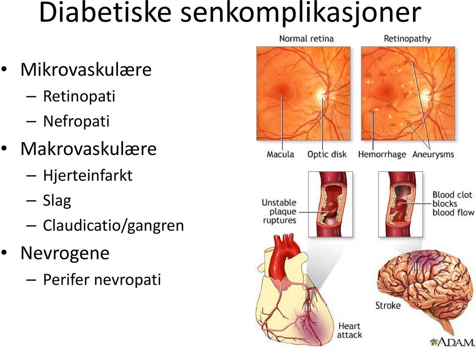 Makrovaskulære Hjerteinfarkt Slag