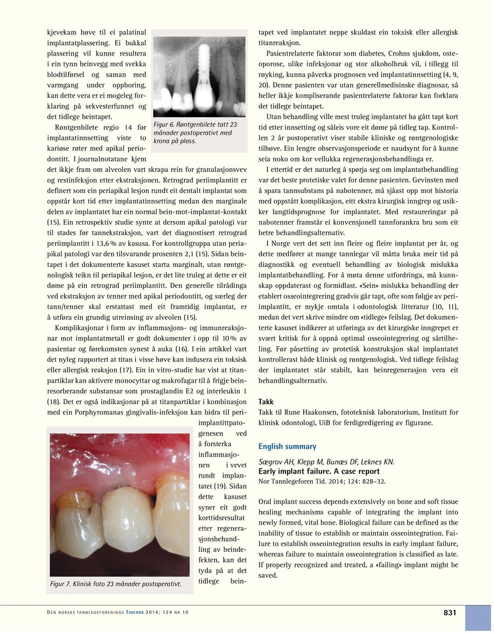 beintapet. Røntgenbilete regio 14 før implantatinnsetting viste to kariøse røter med apikal periodontitt. I journalnotatane kjem Figur 6.