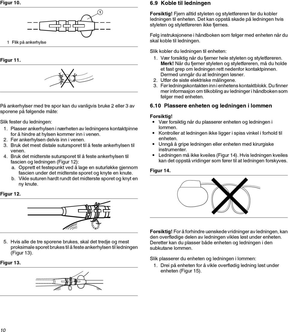 Bruk det mest distale sutursporet til å feste ankerhylsen til venen. 4. Bruk det midterste sutursporet til å feste ankerhylsen til fascien og ledningen (Figur 12): a.