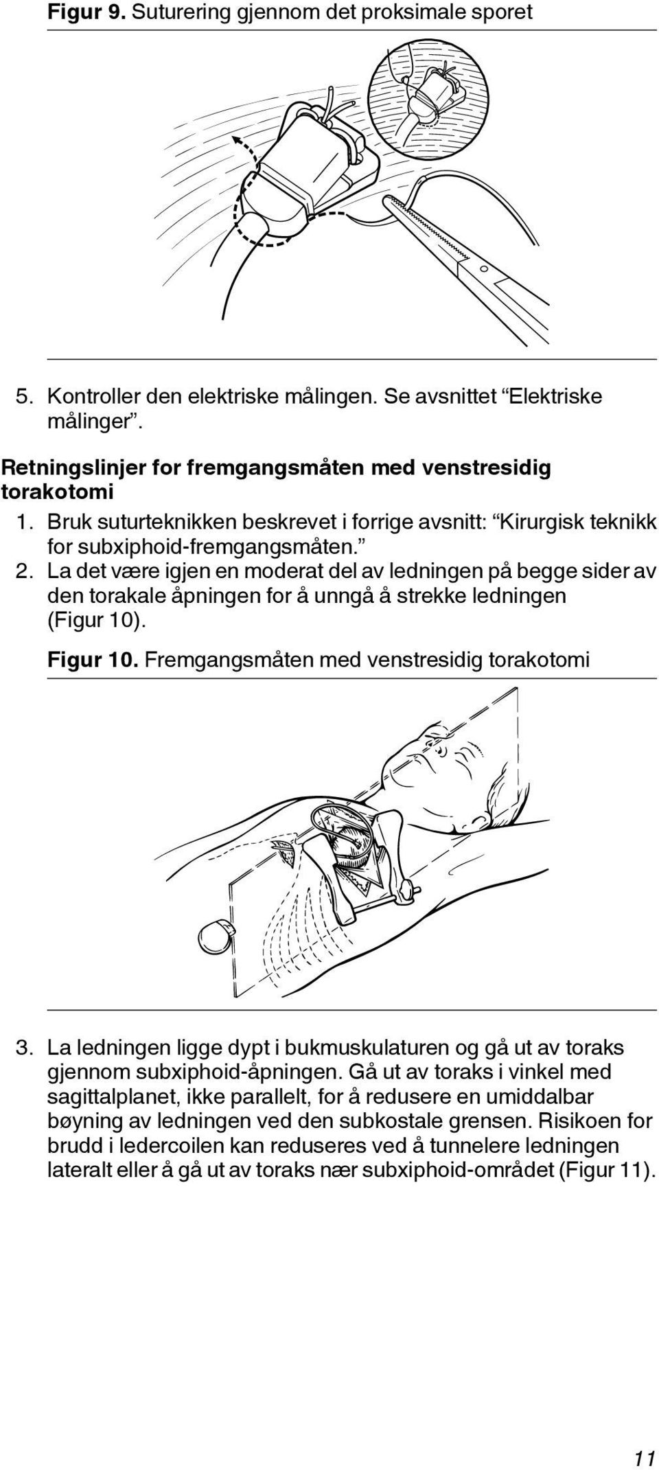 La det være igjen en moderat del av ledningen på begge sider av den torakale åpningen for å unngå å strekke ledningen (Figur 10). Figur 10. Fremgangsmåten med venstresidig torakotomi 3.