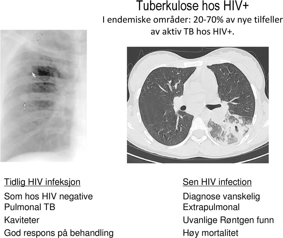 Tidlig HIV infeksjon Som hos HIV negative Pulmonal TB Kaviteter