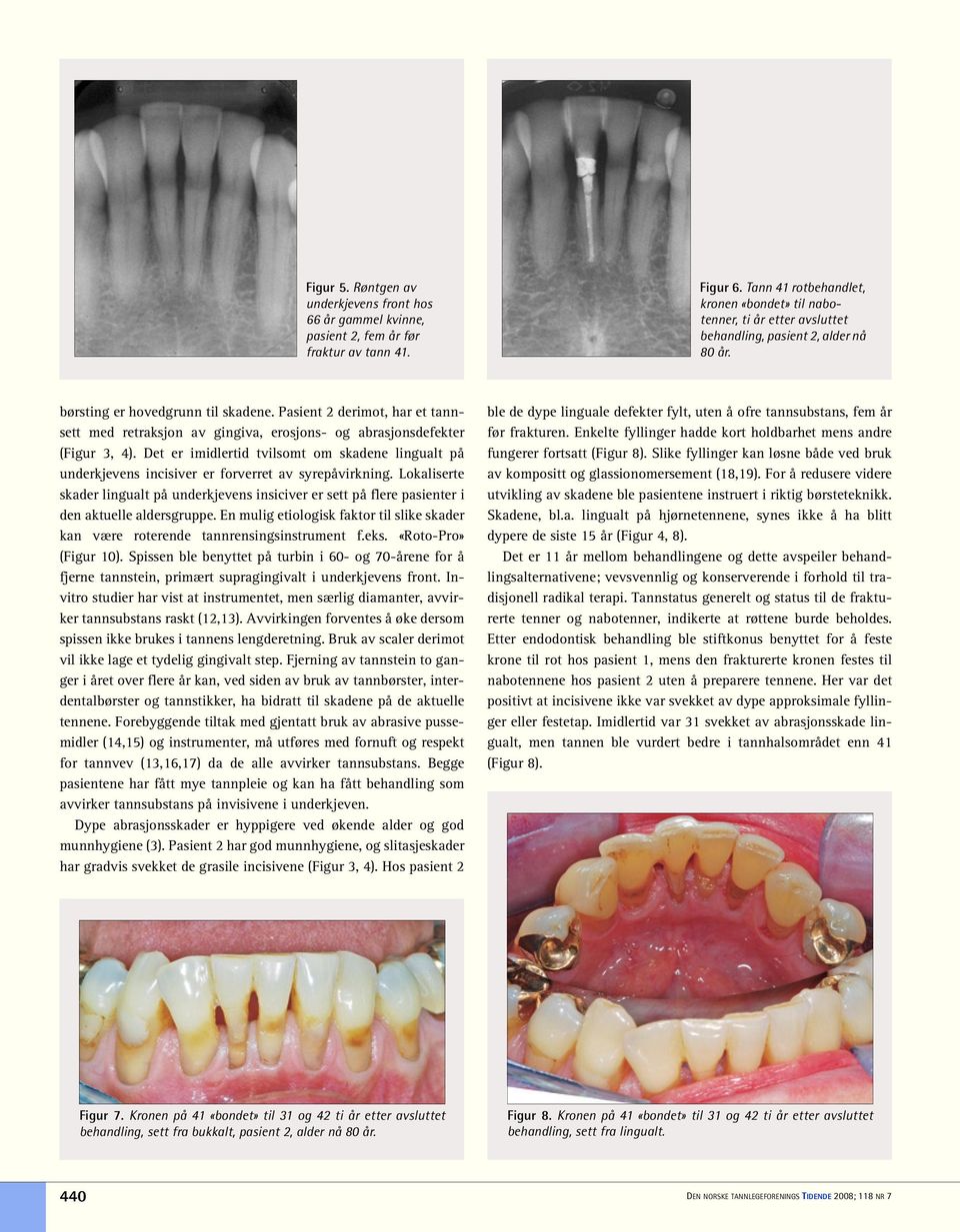 Pasient 2 derimot, har et tannsett med retraksjon av gingiva, erosjons- og abrasjonsdefekter (Figur 3, 4).