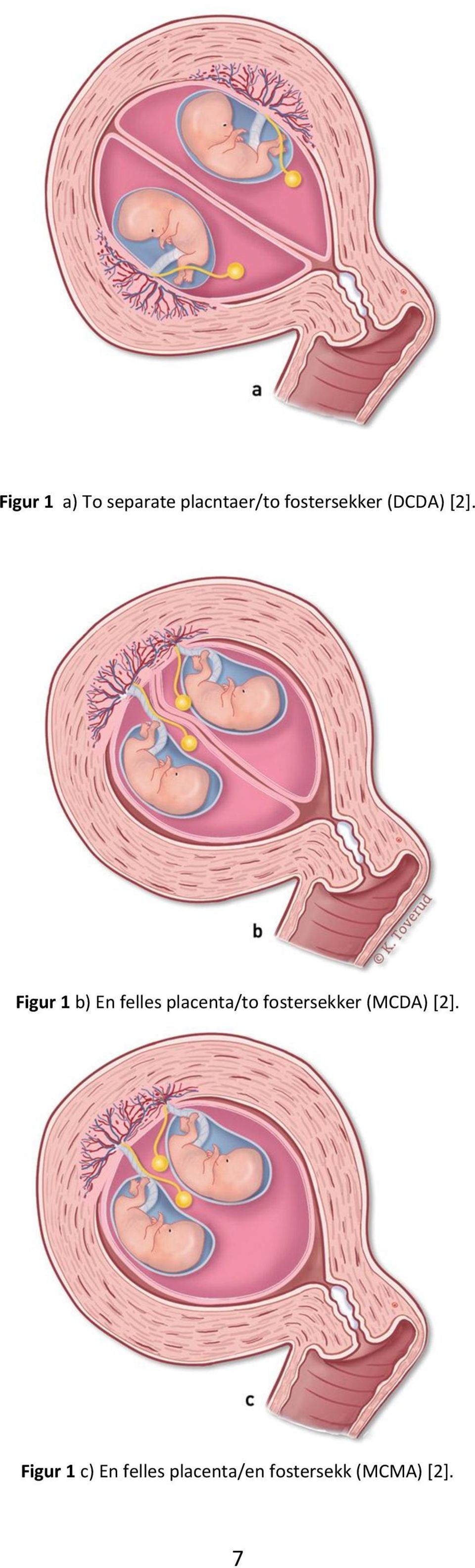 Figur 1 b) En felles placenta/to